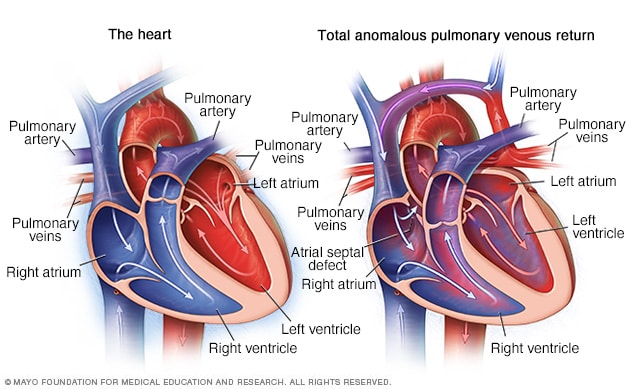 Total Anomalous Pulmonary Venous Return Overview Mayo Clinic 