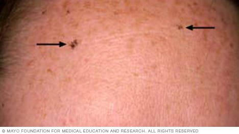 Slide show: Sun damage - Mayo Clinic