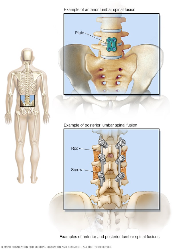 Spinal Fusion Mayo Clinic 3045