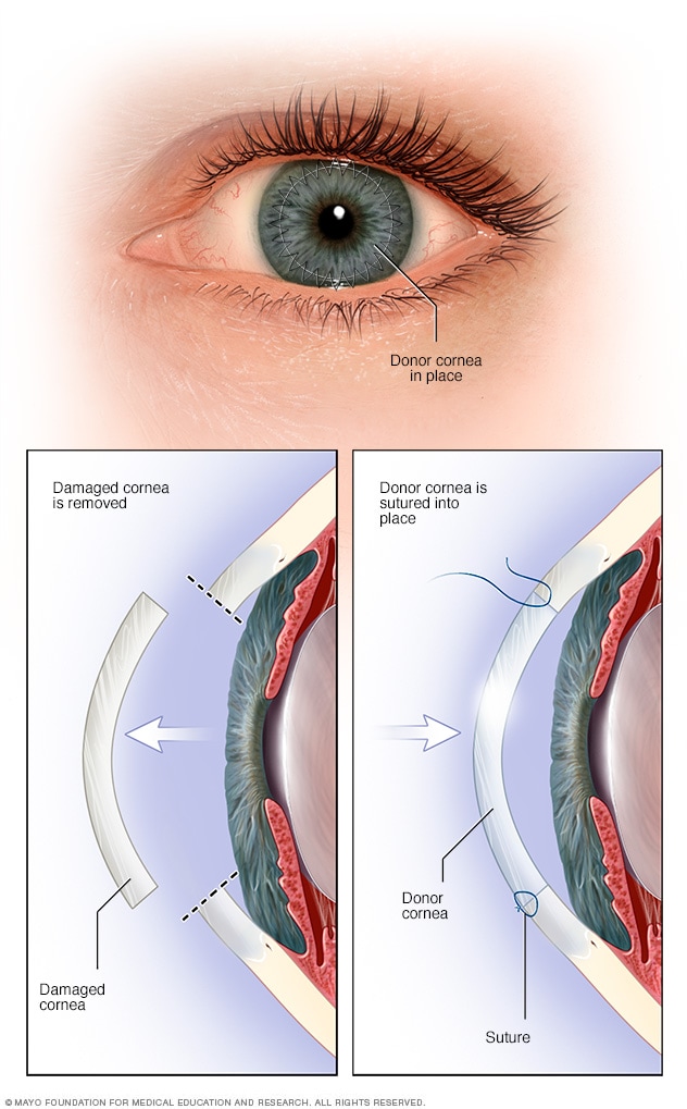 Cornea Transplant - Mayo Clinic