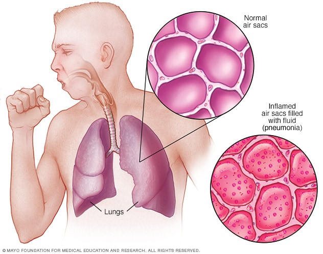 Pneumonia Symptoms And Causes Mayo Clinic