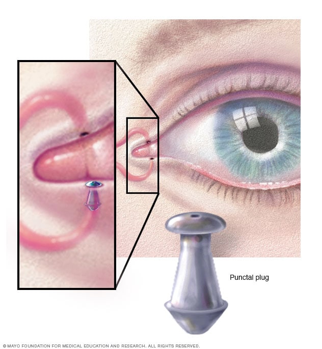 punctal-plugs-mayo-clinic