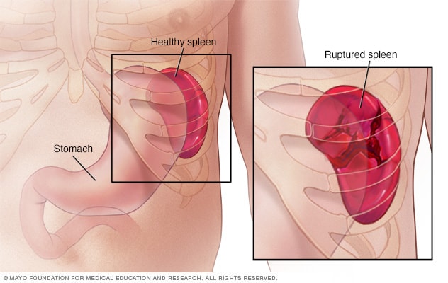 Ruptured spleen - Symptoms and causes - Mayo Clinic