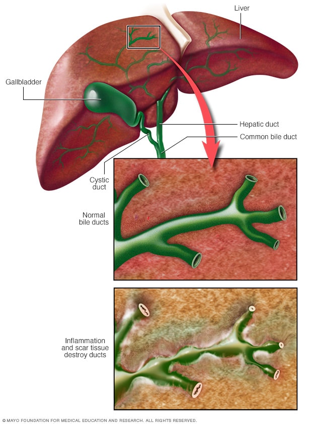 primary-biliary-cholangitis-symptoms-and-causes-mayo-clinic