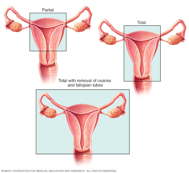 Abdominal Hysterectomy Mayo Clinic