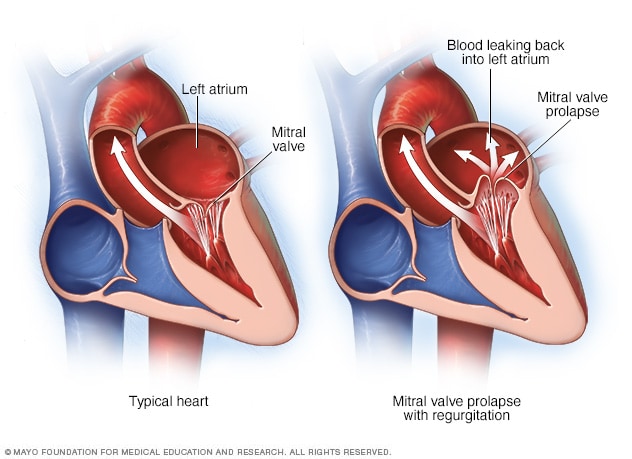 Mitral Valve Prolapse Symptoms And Causes Mayo Clinic