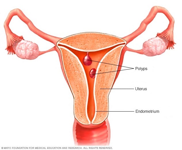 uterine-polyps-symptoms-and-causes-mayo-clinic