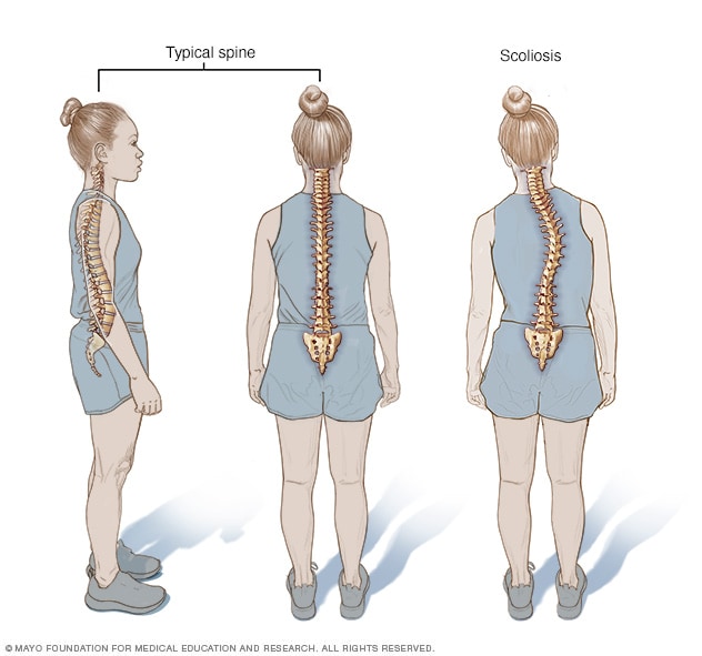 Scoliosis Symptoms and causes Mayo Clinic