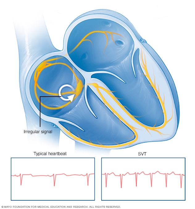 Supraventricular Tachycardia - Symptoms And Causes - Mayo Clinic