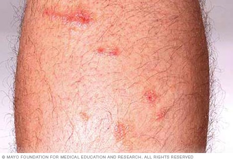 Poison ivy rash - Mayo Clinic