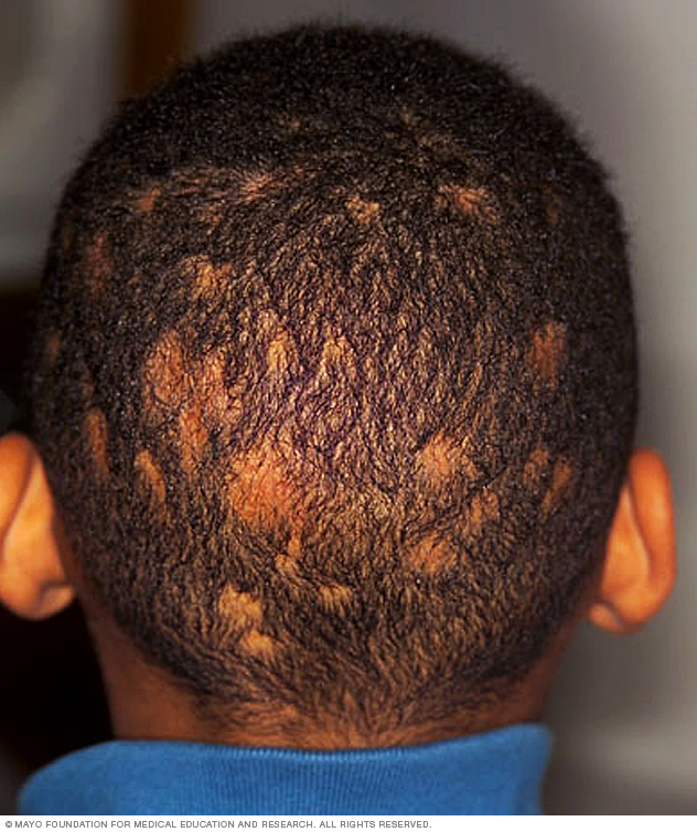 Ringworm scalp Symptoms And Causes Mayo Clinic