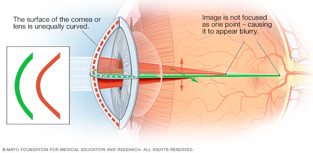 Astigmatism - Symptoms And Causes - Mayo Clinic