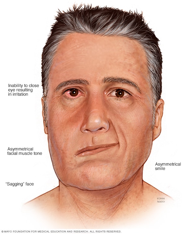  Ramsay Hunt syndrome Symptoms and causes Mayo Clinic