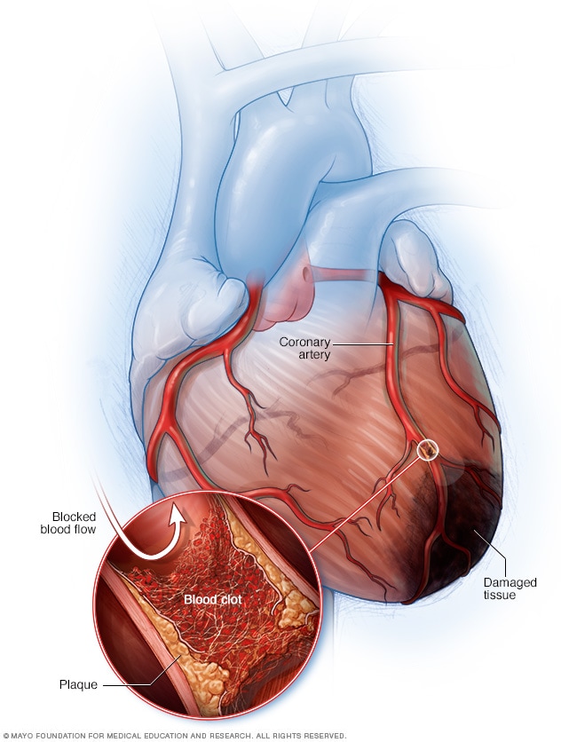 Heart attack Symptoms and causes Mayo Clinic