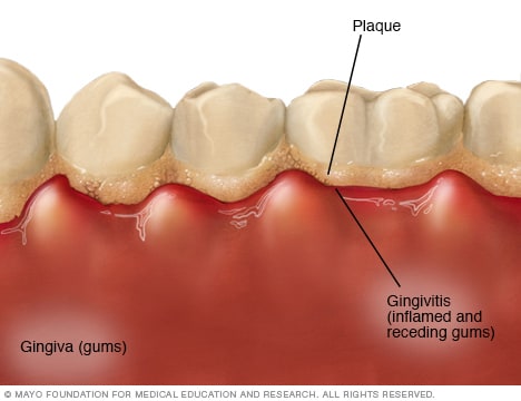 Gingivitis - Symptoms And Causes - Mayo Clinic