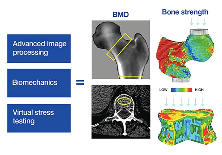 Preventing osteoporosis: The vital role of DEXA scans in predicting future  fractures