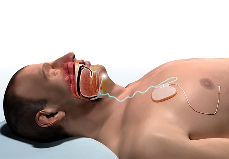 Sleeping Rap Jabardasti Xxx Video - The emerging option of upper airway stimulation therapy - Mayo Clinic