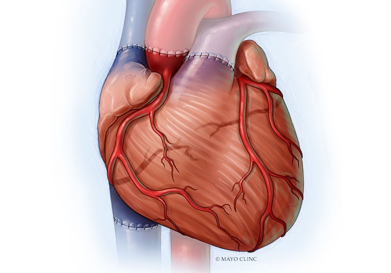 Cardiovascular Diseases and Cardiac Surgery News - Medical ...