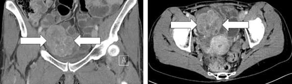 CT images showing pelvic mass
