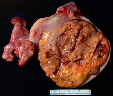Gross pathology cut section of ovarian steroid cell tumor
