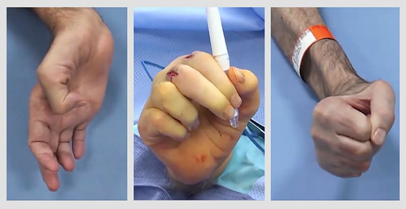 Patient's hand pre- and post-surgery