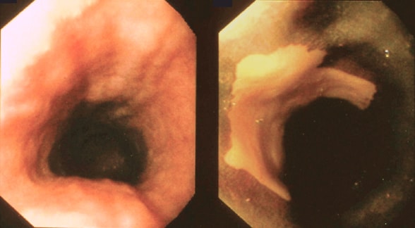 Imagen endoscópica de la mucosa normal en endoscopia de luz blanca y lesión no manchada con cromoendoscopia de Lugol