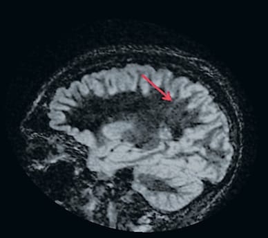 Focal cortical dysplasia less clearly visible in 3-Tesla
