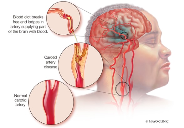 Proceso por el cual la enfermedad de las arterias carótidas conduce a un accidente cerebrovascular