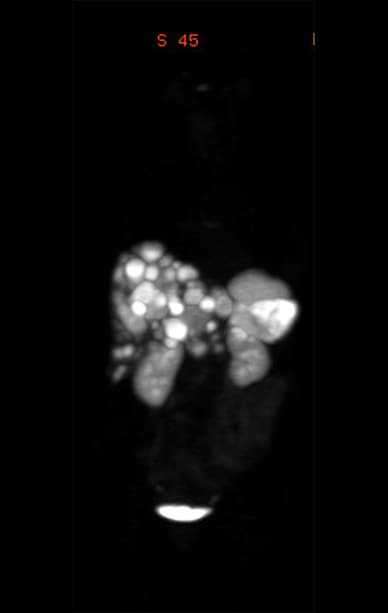 PET scan of primary pancreatic neuroendocrine tumor and diffuse liver metastases 