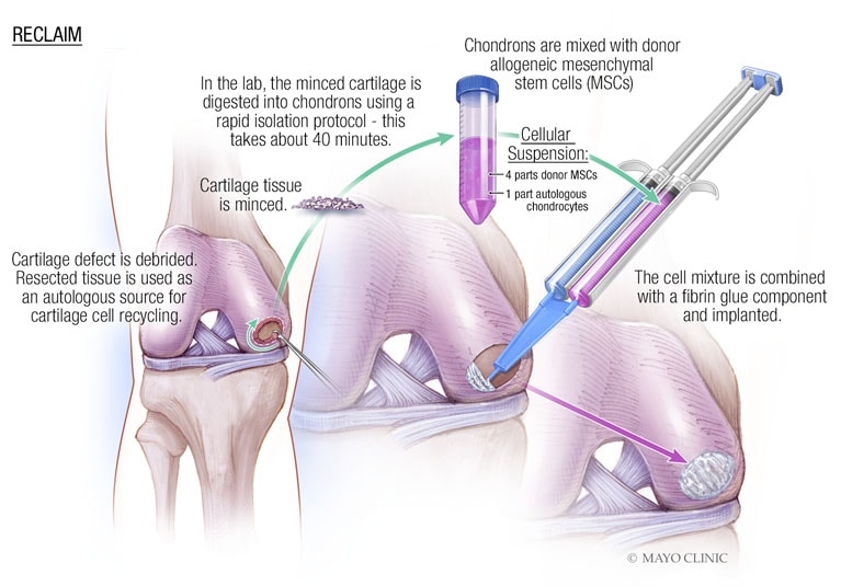 OA Novel Medial Osteoarthritis Knee Brace - United Ortho