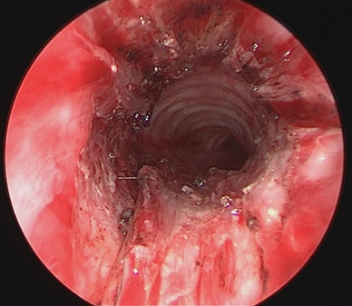 Postoperative appearance of the same stenosis