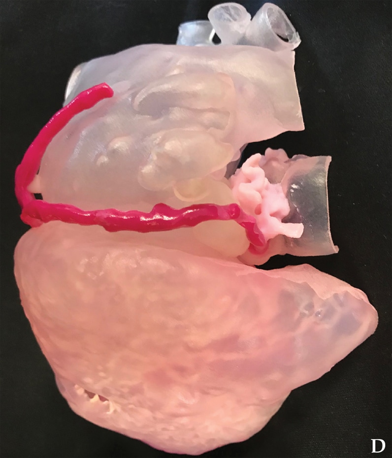 心脏外部形态及假性动脉瘤与右冠状动脉的关系