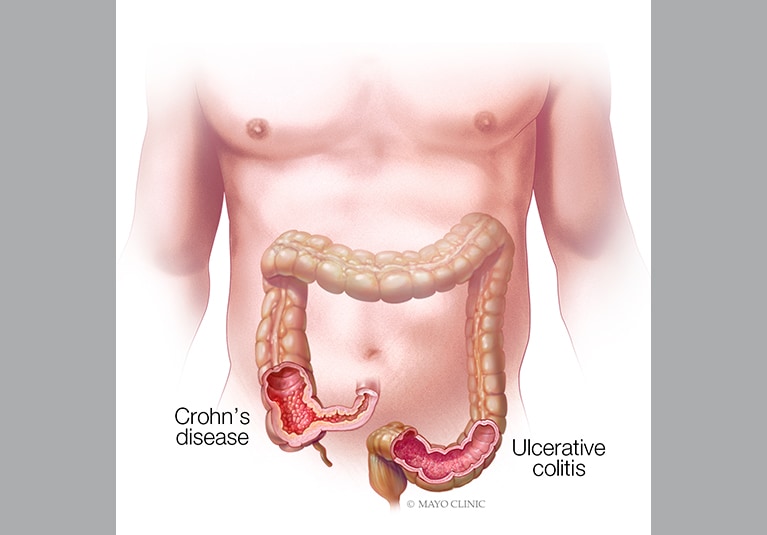 Advances in the treatment of Crohn's disease and ulcerative colitis - Mayo  Clinic