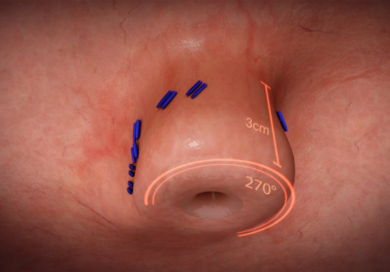 How To Bill Endoscopic Transoral Incisionless Fundoplasty With 