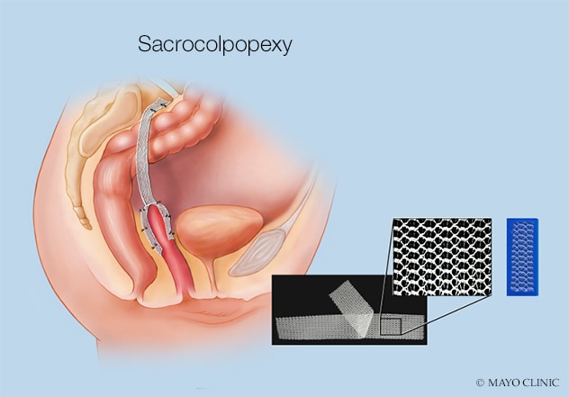 Sacrocolpopexy: Purpose, Procedure, Risks, Results & Recovery