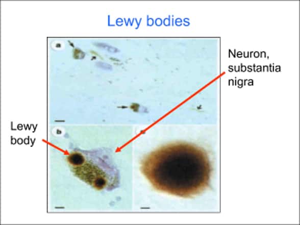 Neurona en la sustancia negra con cuerpos de Lewy