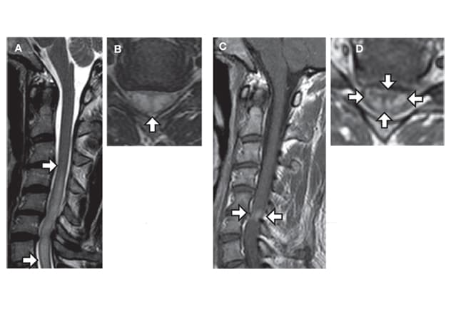 Pattern characteristic of cervical spondylotic myelopathy with enhancement
