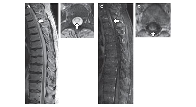 Pattern characteristic of spinal cord sarcoidosis