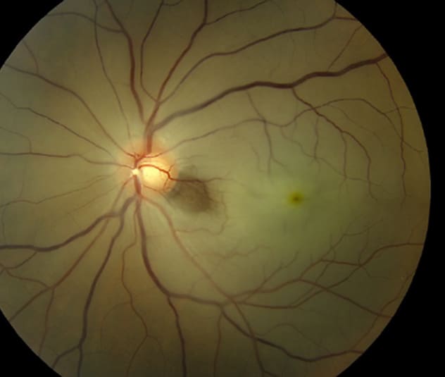 An acute central retinal artery occlusion