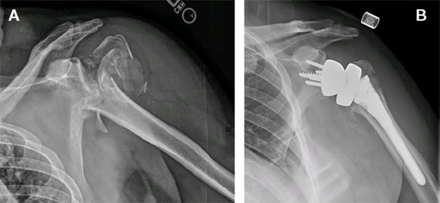 肱骨近端骨折治疗前和治疗后的 X 线图像