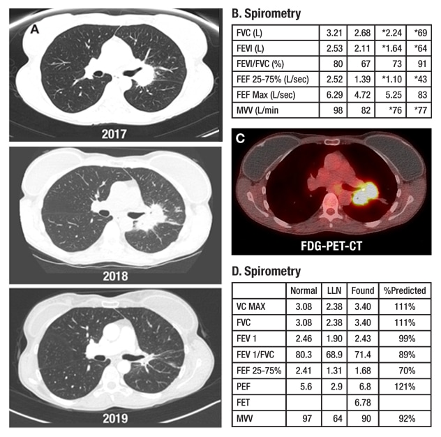 Serial CT images of progressive fibrosing mediastinitis