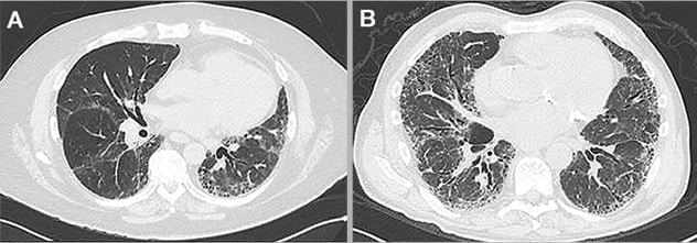 Imágenes por tomografía computarizada de fibrosis pulmonar idiopática