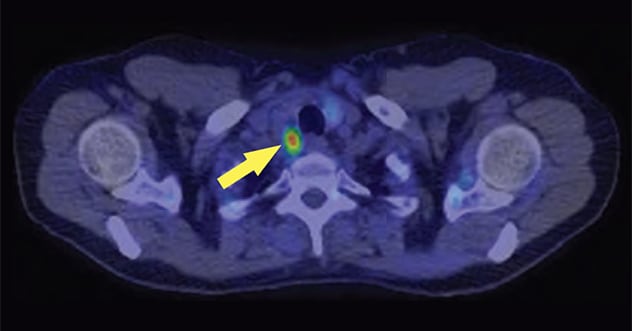Focal choline uptake posterior to the right thyroid lobe corresponding to a parathyroid adenoma