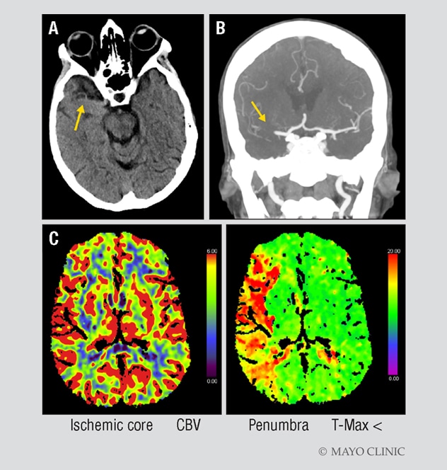 Imagen de tomografía computarizada de una mujer con signos de accidente cerebrovascular isquémico agudo