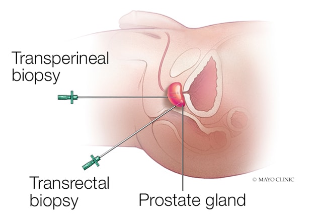 Transperineal and transrectal biopsy needle course