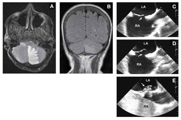 诊断为大的卵圆孔未闭伴房间隔动脉瘤（已经经皮闭塞）的患者的磁共振成像 (MRI) 和经食管超声心动图检查。