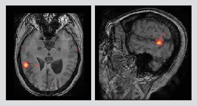 Axial and sagittal images from SISCOM show seizure onset.