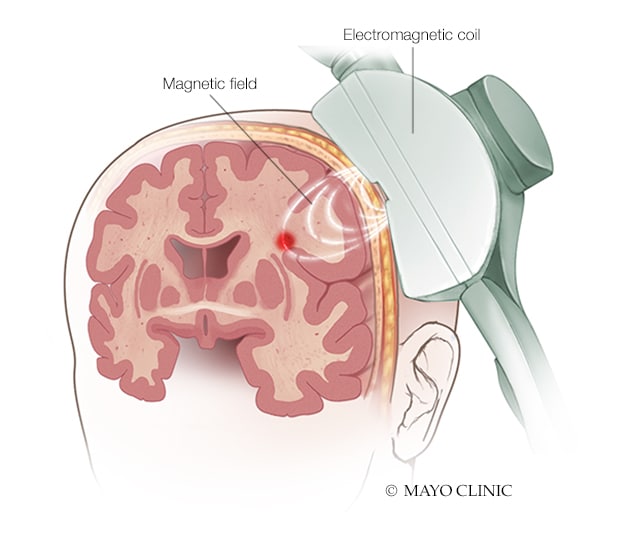 Repetitive transcranial magnetic stimulation