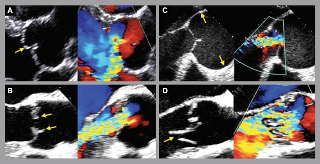 Four transthoracic images illustrating mechanisms of aortic valve regurgitation
