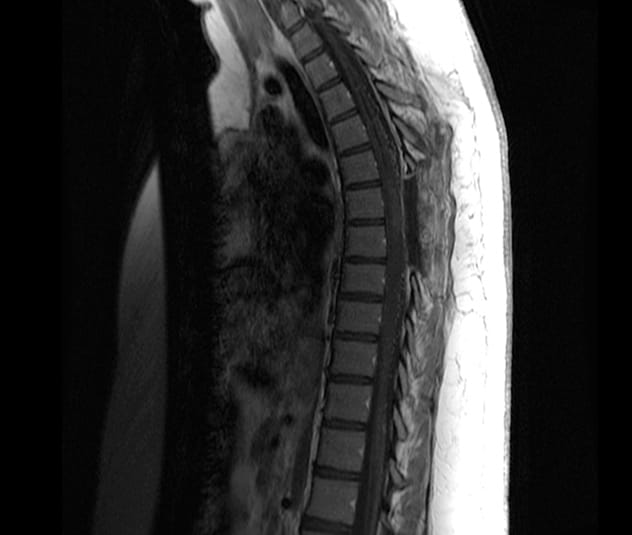 术后磁共振成像 (MRI) 显示无肿瘤残留和空洞消退